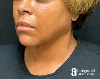 FaceTite & AccuTite Before & After Gallery - Patient 89349657 - Image 2