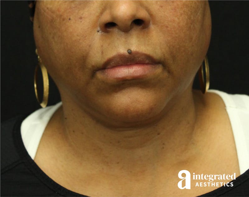 FaceTite & AccuTite Before & After Gallery - Patient 89349657 - Image 3