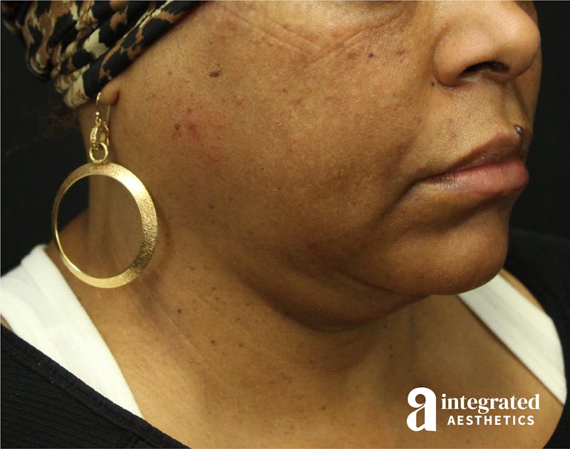 FaceTite & AccuTite Before & After Gallery - Patient 89349657 - Image 7