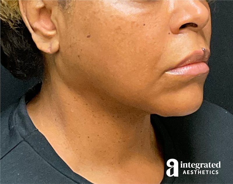 FaceTite & AccuTite Before & After Gallery - Patient 89349657 - Image 8