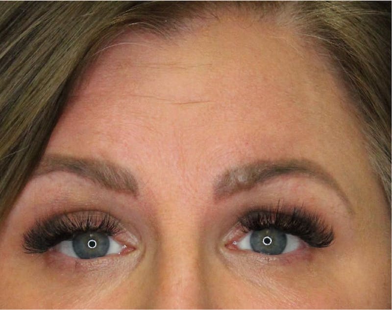 Wrinkle Relaxers Before & After Gallery - Patient 90700030 - Image 1