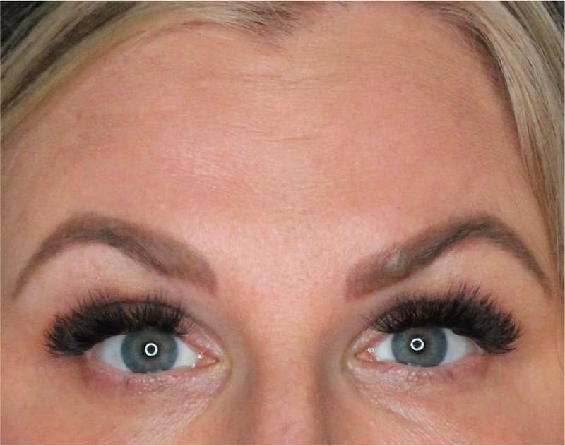 Wrinkle Relaxers Before & After Gallery - Patient 90700030 - Image 2