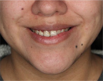 Wrinkle Relaxers Before & After Gallery - Patient 90700078 - Image 2