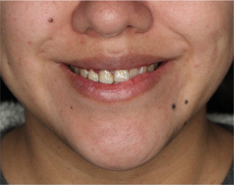 Wrinkle Relaxers Before & After Gallery - Patient 90700078 - Image 2