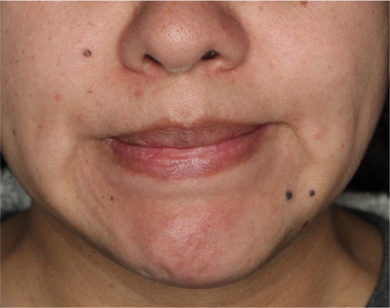 Wrinkle Relaxers Before & After Gallery - Patient 90700078 - Image 4