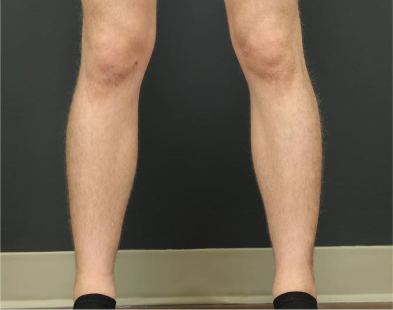 Calf Sculpting Before & After Gallery - Patient 90700495 - Image 2