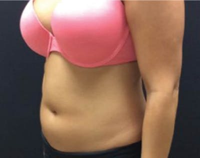 CoolSculpting Before & After Gallery - Patient 90700499 - Image 1