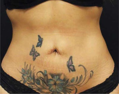 CoolSculpting Before & After Gallery - Patient 90700562 - Image 2