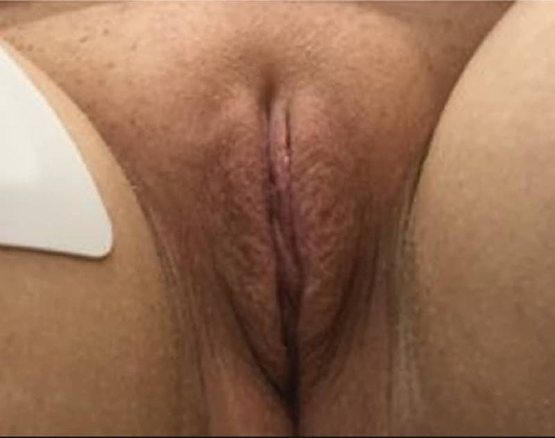 Labiaplasty Before & After Gallery - Patient 90700569 - Image 2
