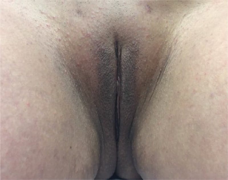 Labiaplasty Before & After Gallery - Patient 90700578 - Image 2