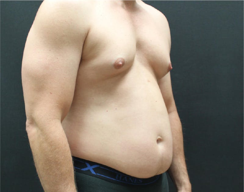Liposuction Before & After Gallery - Patient 90700586 - Image 1