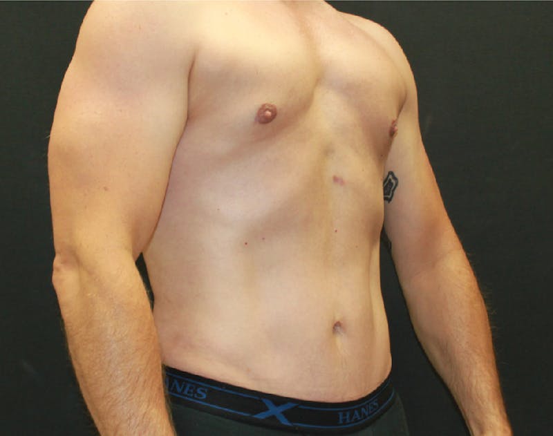 Liposuction Before & After Gallery - Patient 90700586 - Image 2