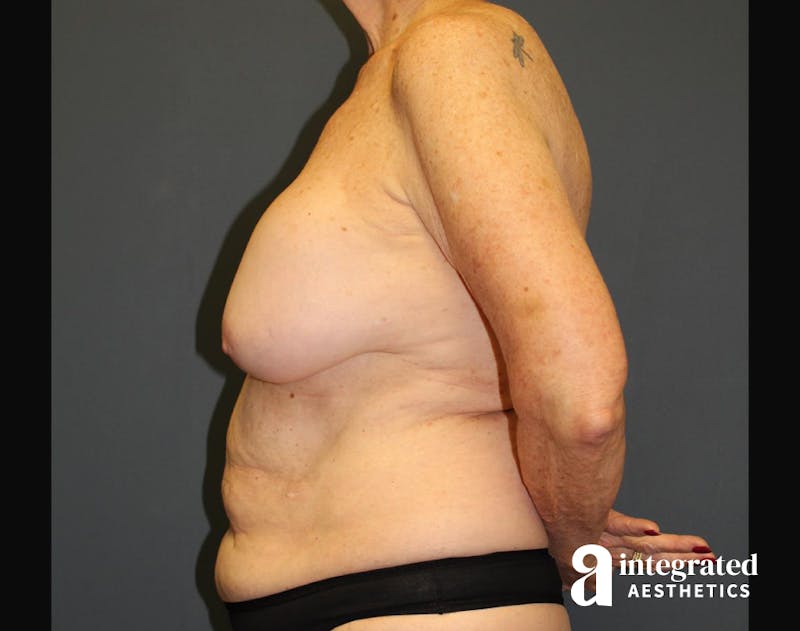 Liposuction Before & After Gallery - Patient 90700604 - Image 5