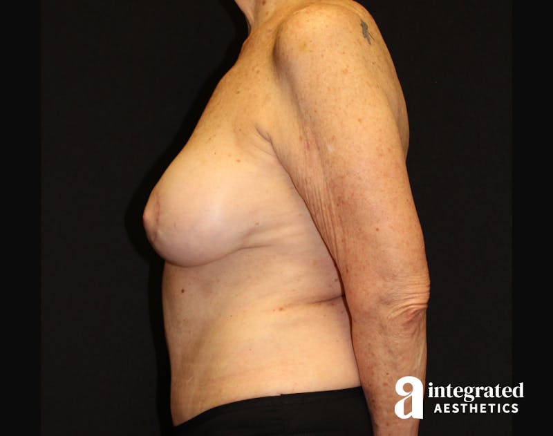 Liposuction Before & After Gallery - Patient 90700604 - Image 6
