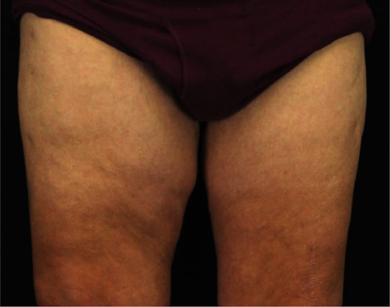 Thigh Lift Before & After Gallery - Patient 90700603 - Image 2