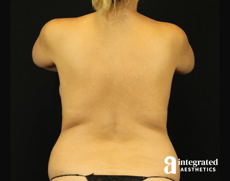 Mommy Makeover Before & After Gallery - Patient 90700615 - Image 9