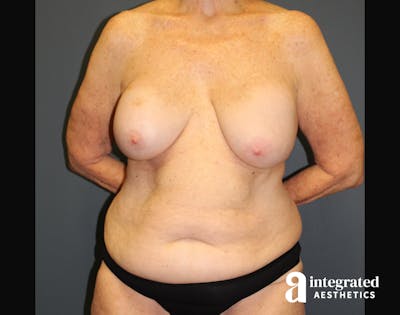 Mommy Makeover Before & After Gallery - Patient 90700641 - Image 1