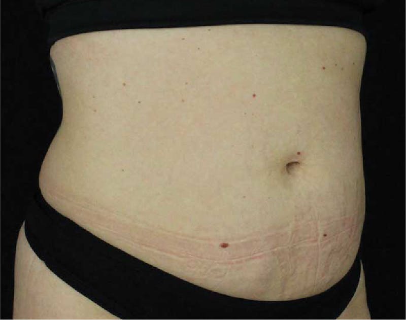 Tummy Tuck Before & After Gallery - Patient 90700643 - Image 1