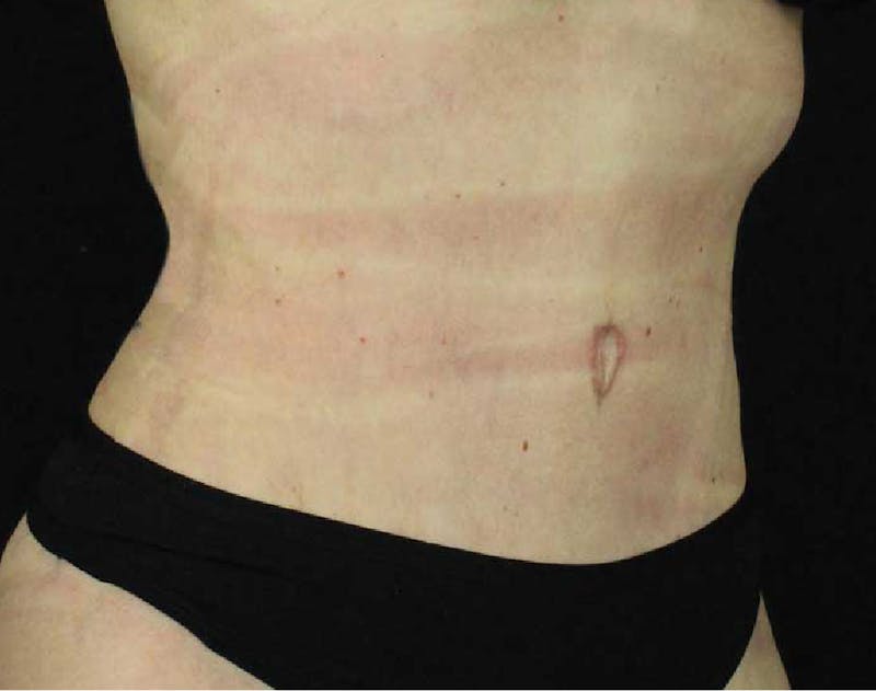 Tummy Tuck Before & After Gallery - Patient 90700643 - Image 2