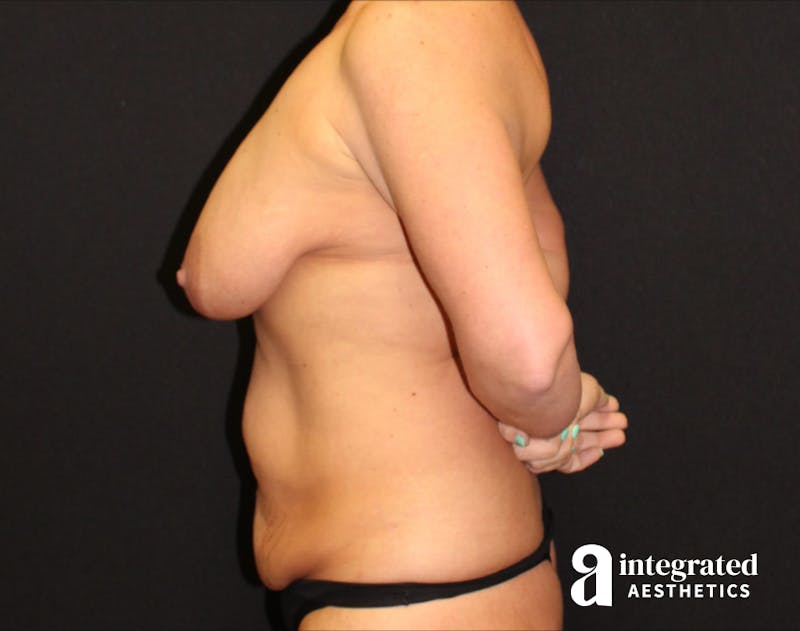 Tummy Tuck Before & After Gallery - Patient 90700665 - Image 3