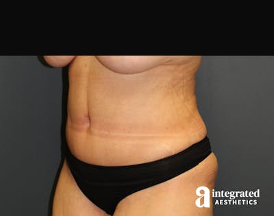 Tummy Tuck Before & After Gallery - Patient 90700692 - Image 2