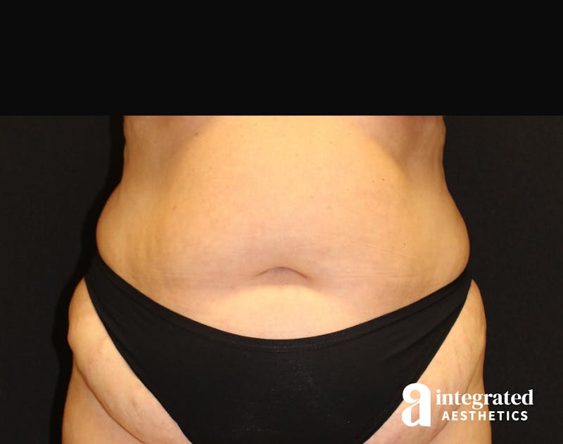 Tummy Tuck Before & After Gallery - Patient 90700692 - Image 3
