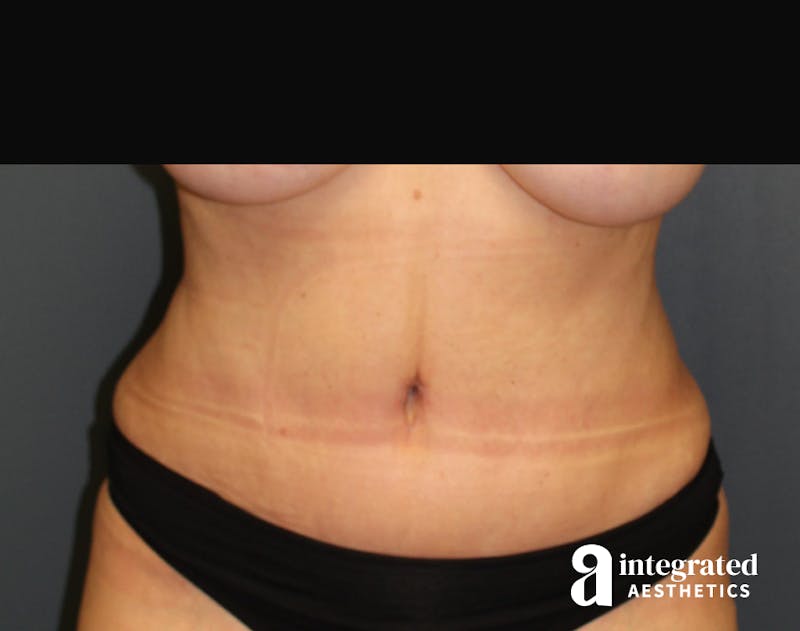Tummy Tuck Before & After Gallery - Patient 90700692 - Image 4