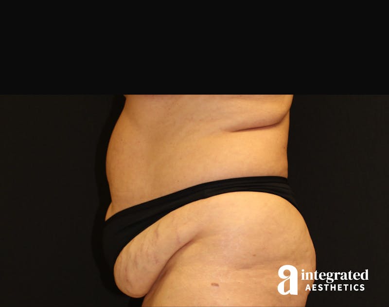Tummy Tuck Before & After Gallery - Patient 90700692 - Image 5