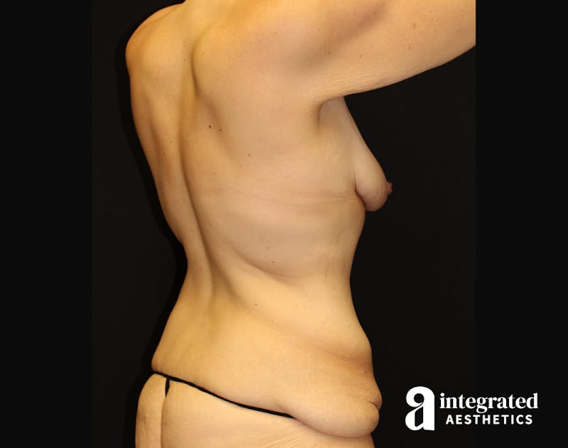 Mommy Makeover Before & After Gallery - Patient 90700682 - Image 9