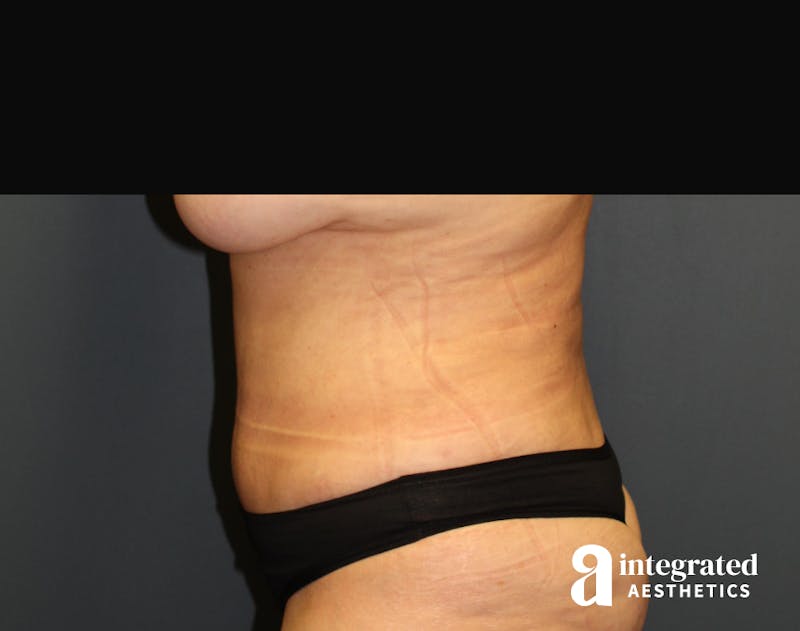 Tummy Tuck Before & After Gallery - Patient 90700692 - Image 6
