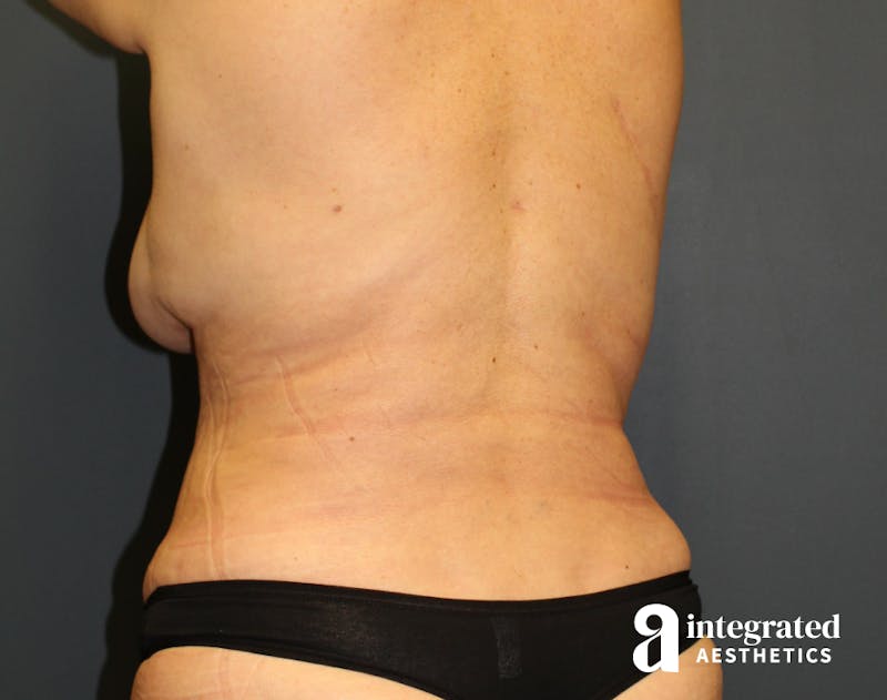 Tummy Tuck Before & After Gallery - Patient 90700692 - Image 8