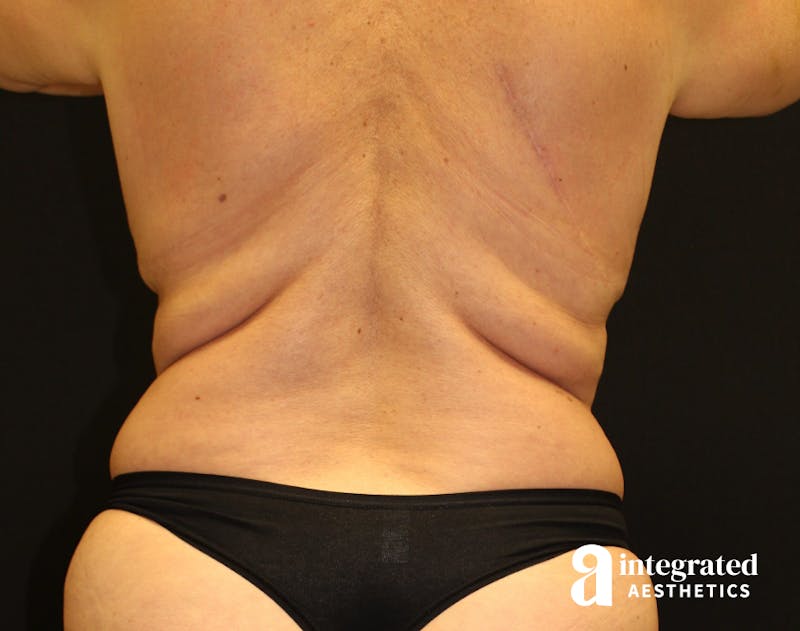 Tummy Tuck Before & After Gallery - Patient 90700692 - Image 9