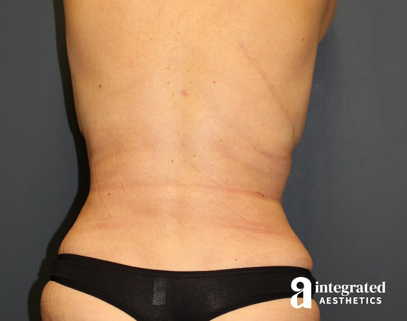 Tummy Tuck Before & After Gallery - Patient 90700692 - Image 10