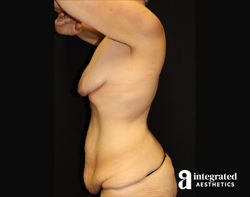 Tummy Tuck Before & After Gallery - Patient 90700698 - Image 3