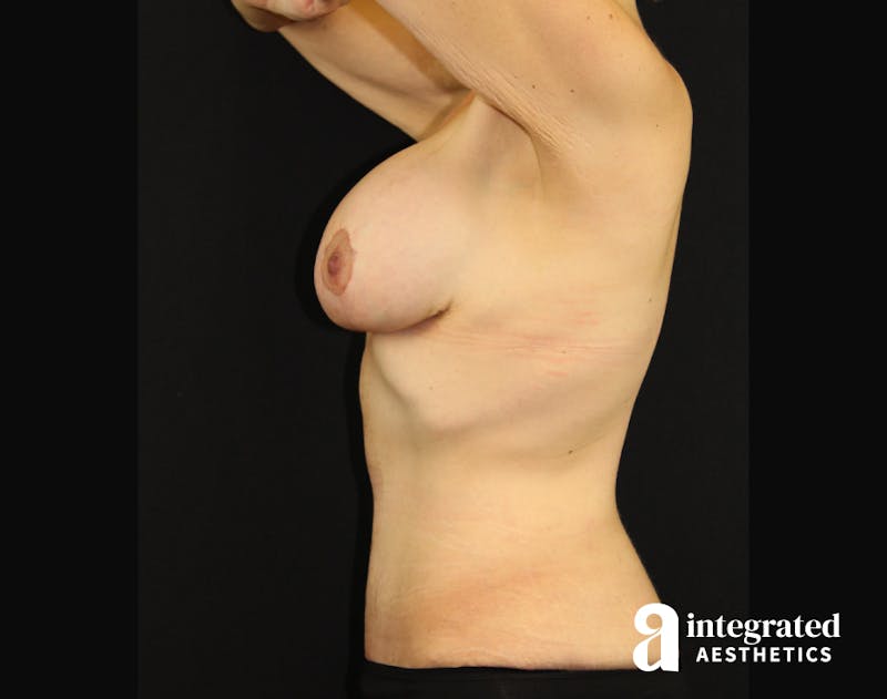 Tummy Tuck Before & After Gallery - Patient 90700698 - Image 4
