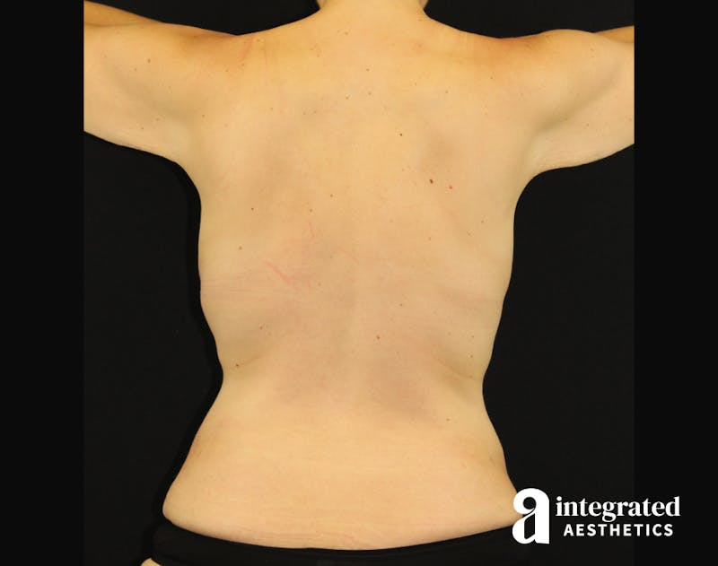 Tummy Tuck Before & After Gallery - Patient 90700698 - Image 8