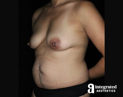 Mommy Makeover Before & After Gallery - Patient 90700712 - Image 1