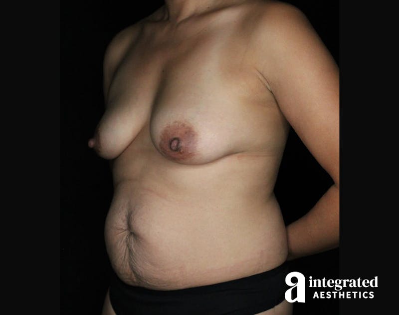 Mommy Makeover Before & After Gallery - Patient 90700712 - Image 1