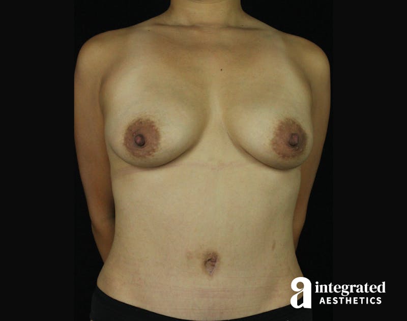 Tummy Tuck Before & After Gallery - Patient 90700713 - Image 4