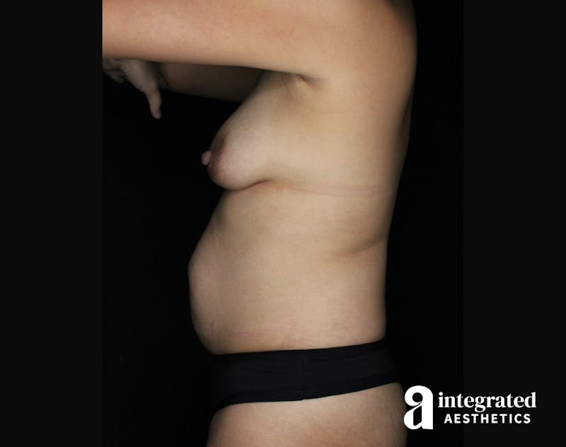 Tummy Tuck Before & After Gallery - Patient 90700713 - Image 5