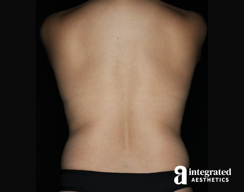 Mommy Makeover Before & After Gallery - Patient 90700712 - Image 9