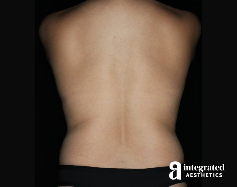Tummy Tuck Before & After Gallery - Patient 90700713 - Image 9