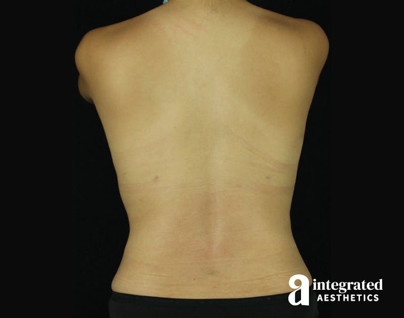 Tummy Tuck Before & After Gallery - Patient 90700713 - Image 10