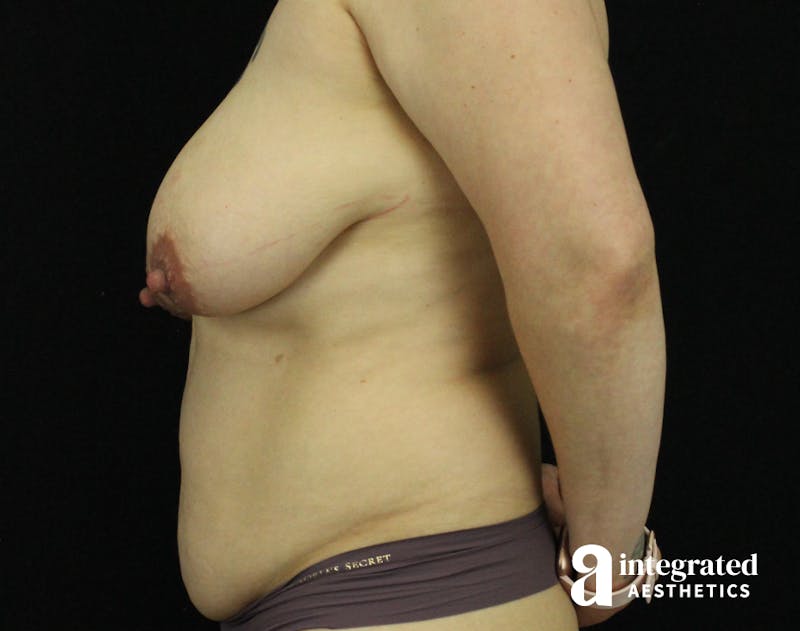 Tummy Tuck Before & After Gallery - Patient 90700726 - Image 5
