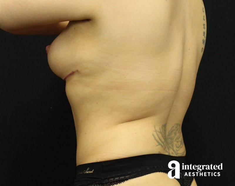 Tummy Tuck Before & After Gallery - Patient 90700726 - Image 8