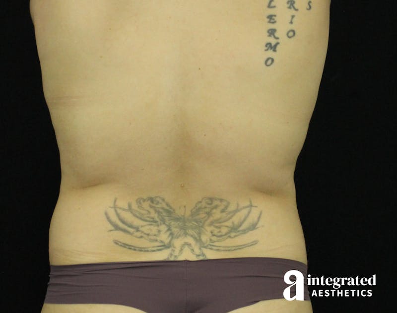Tummy Tuck Before & After Gallery - Patient 90700726 - Image 9