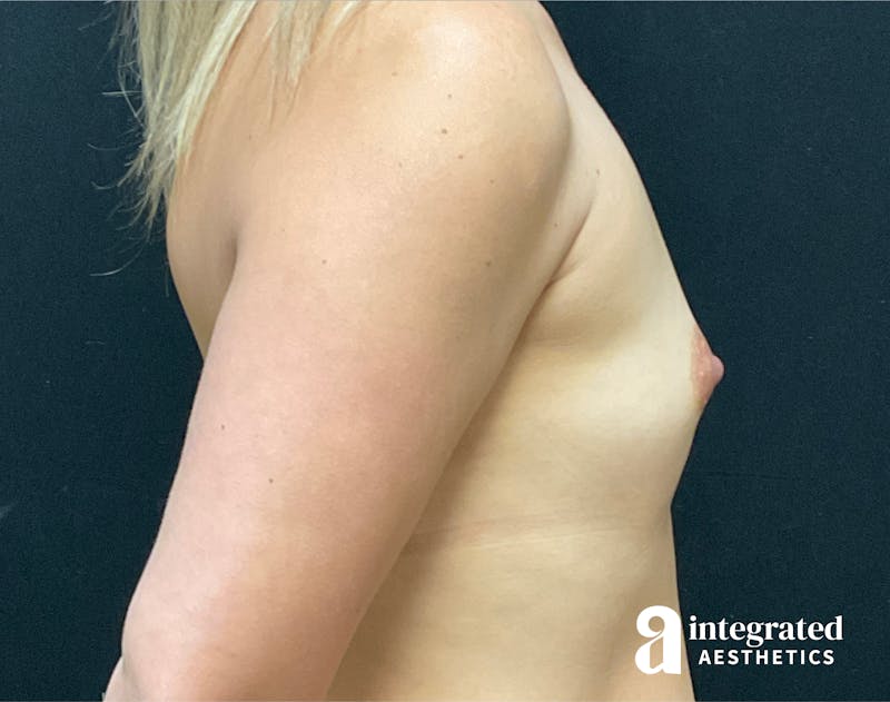 Breast Augmentation Before & After Gallery - Patient 90700795 - Image 5