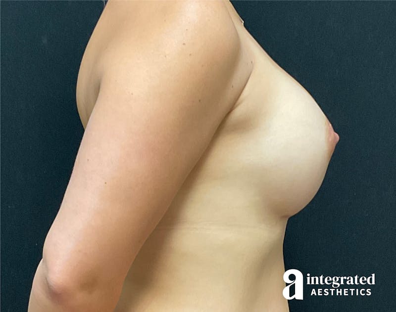 Breast Augmentation Before & After Gallery - Patient 90700795 - Image 6