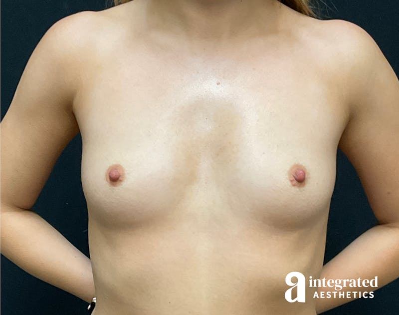 Breast Augmentation Before & After Gallery - Patient 90702281 - Image 1