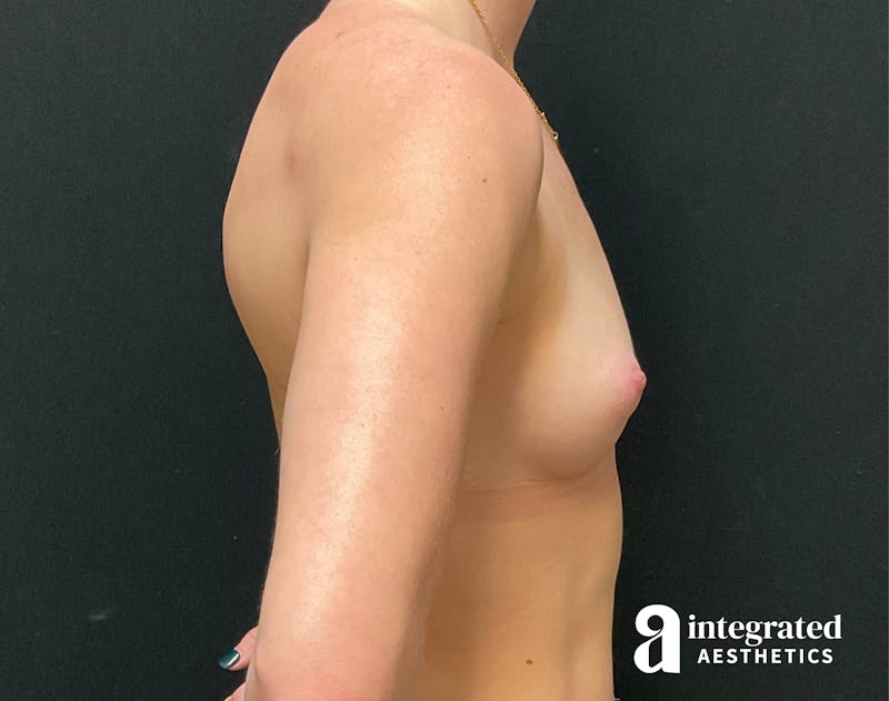 Breast Augmentation Before & After Gallery - Patient 90702319 - Image 5
